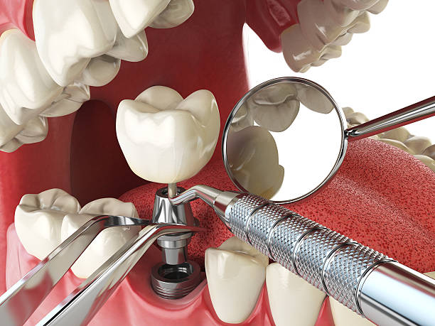 Best Emergency Dental Care for Broken or Chipped Teeth in Centreville, MI